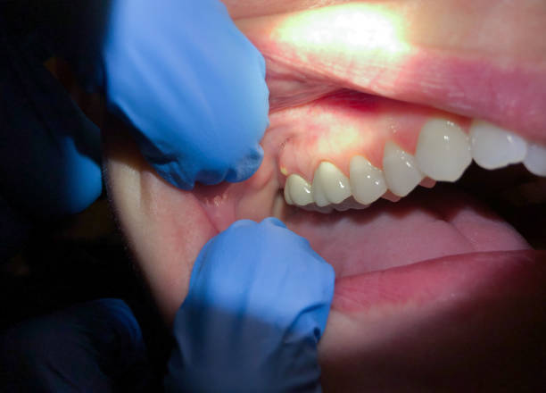 Best Emergency Tooth Extraction in Fresno, TX